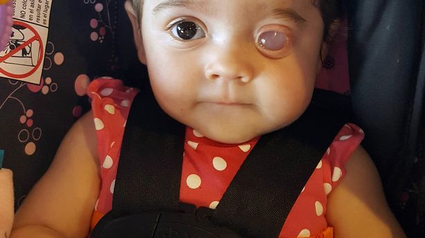 Bedårende baby født med ett øye for å gjennomgå en slitsom prosedyre for å STRETKE stikkontakten