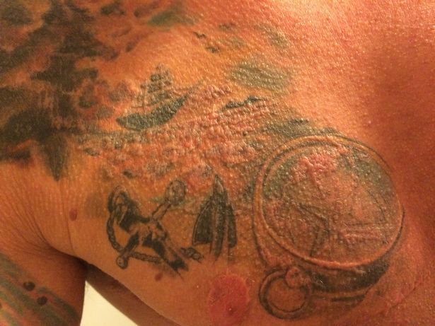 Fixadores de tatuagem arruinam a vida de Brix com cicatrizes